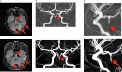 Antiphospholipid syndrome onset with hemolytic anemia and accompanied cardiocerebral events: a case report